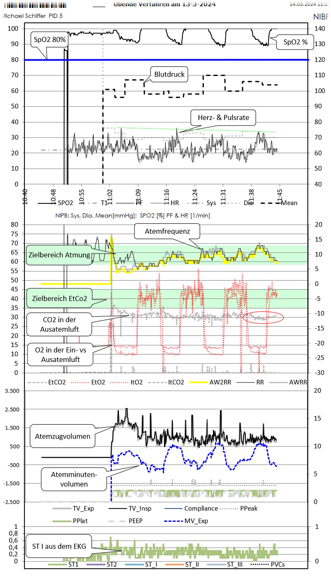 IHHT Protokoll mit EtCO2 SpO2 und Atemzugvolumen